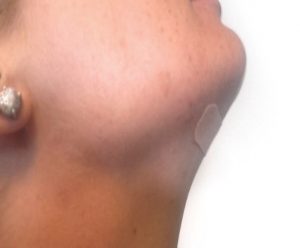medical_taping_kwijlen2